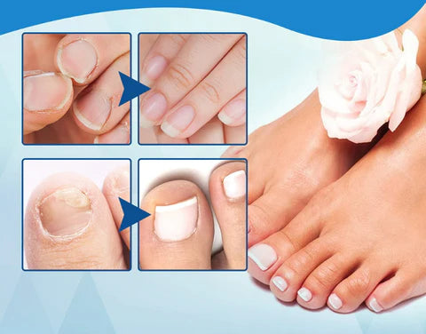 Antifungal Laser Device