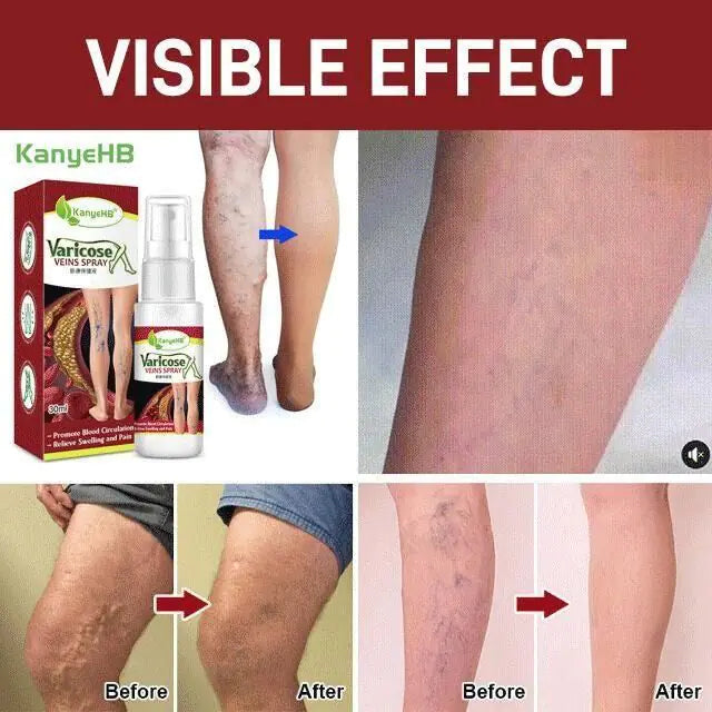Varicose Veins Treatment Spray/Skin care