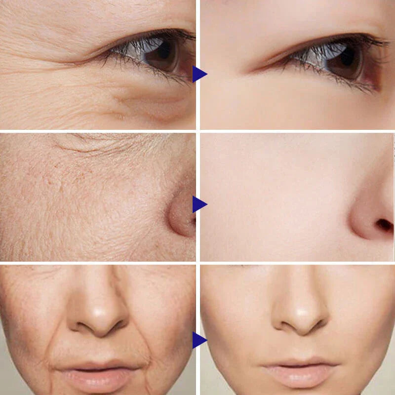Before and after comparison of facial skin showing reduced wrinkles and smoother texture