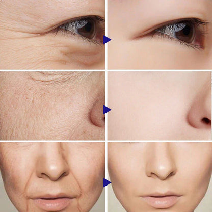 Before and after comparison of facial skin showing reduced wrinkles and smoother texture