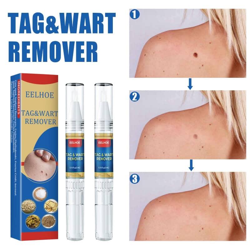 Tag and wart remover