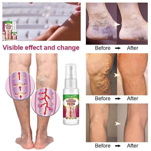 Varicose Veins Treatment Spray/Skin care