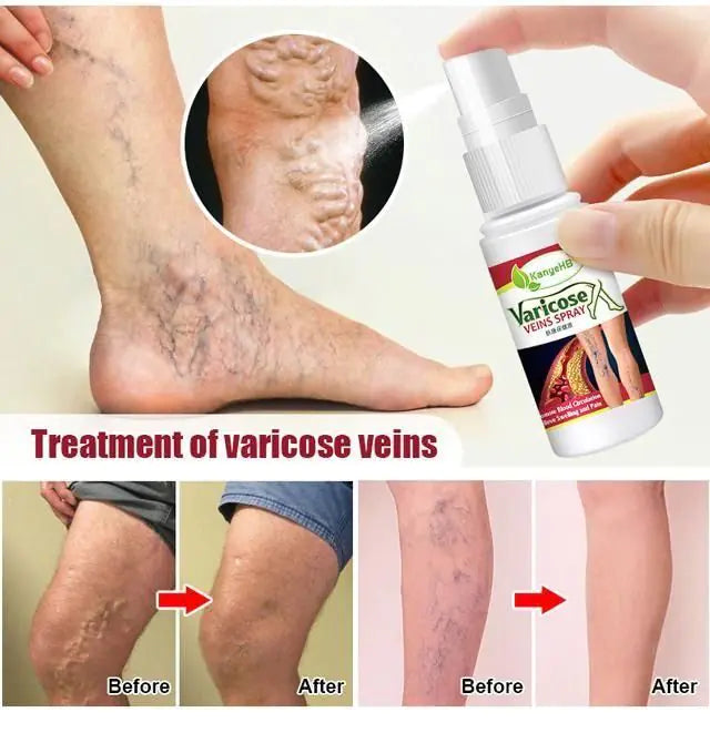 Varicose Veins Treatment Spray/Skin care