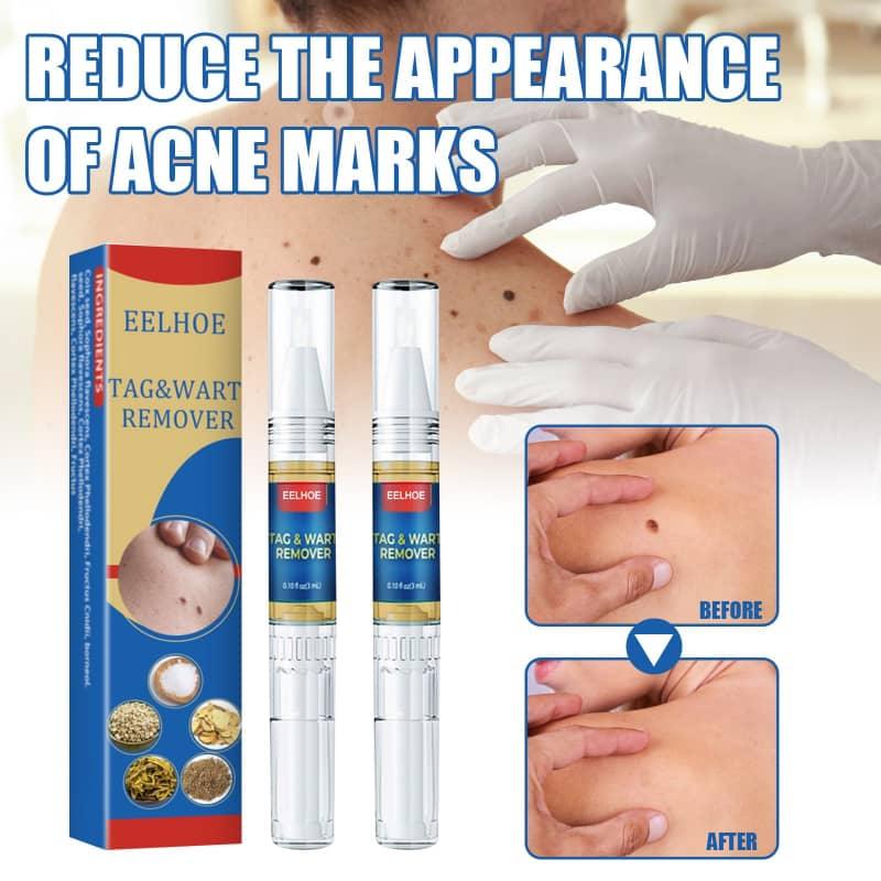 Reduce the appearance of acne marks