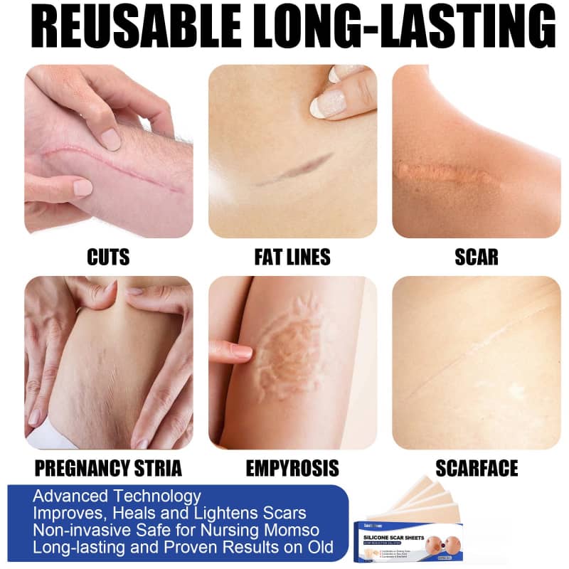 Silicone Scar Patches (4-Pack)